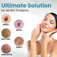 Non-Invasive Mole and Wart Removal Pen