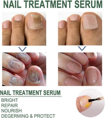 Fast Nail Fungus Remover