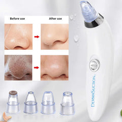 DermaSuction Cell Operated Blackhead Remover with 4 Suction Heads